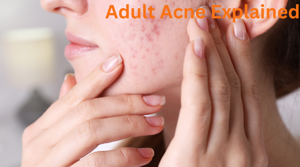 Adult Acne Explained: Your Complete Beginner's Guide to Gentle, Effective Treatment
