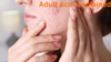 Adult Acne Explained: Your Complete Beginner's Guide to Gentle, Effective Treatment