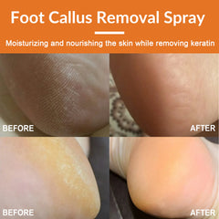 Foot callus removal spray before and after effect on skin